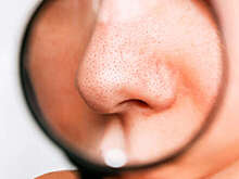 Врач Соколова: агрессивное высушивание кожи провоцирует появление черных точек