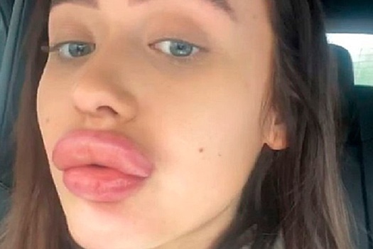Девушка слишком увеличила губы и заперлась дома