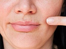 Дерматолог предостерегла от выдавливания прыщей в «треугольнике смерти»