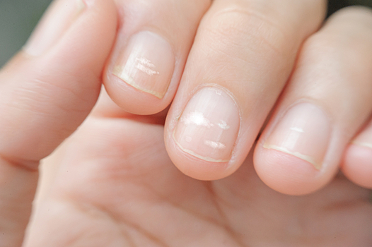 Терапевт заявила об отсутствии опасности белых пятен на ногтях