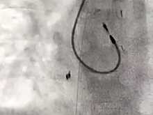 Следователи проверят новосибирских врачей, оставивших катетер в теле пациента