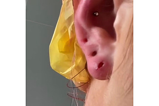 У девушки «отпал кусок уха» из-за дешевых сережек