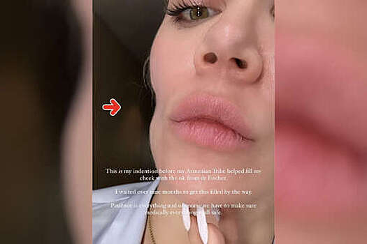 Звезда реалити-шоу Хлои Кардашьян показала ямку на щеке после рака