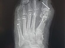 В Красногорской городской больнице № 1 вылечили женщину с тяжелой деформацией стопы