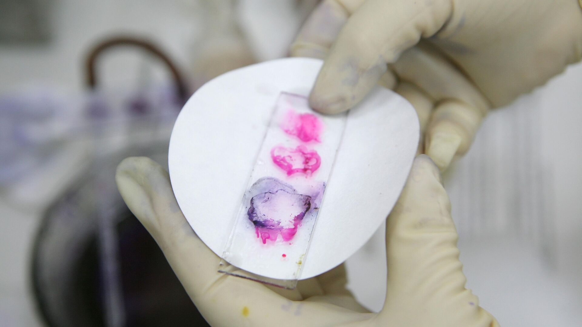 Роспотребнадзор исключил угрозу распространения сибирской язвы в РФ