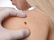 Может ли родинка переродиться в рак