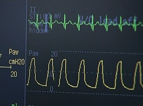Ученые разработали кардиостимулятор, заряжающийся от биения сердца