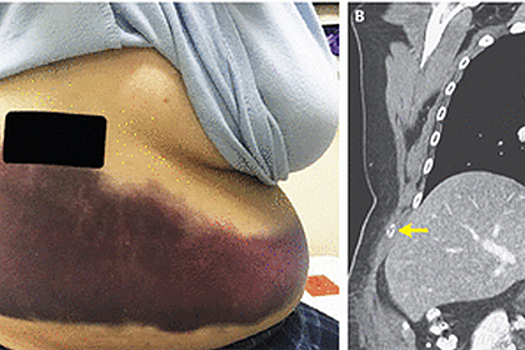 Американка доказала, что кашель может ломать кости