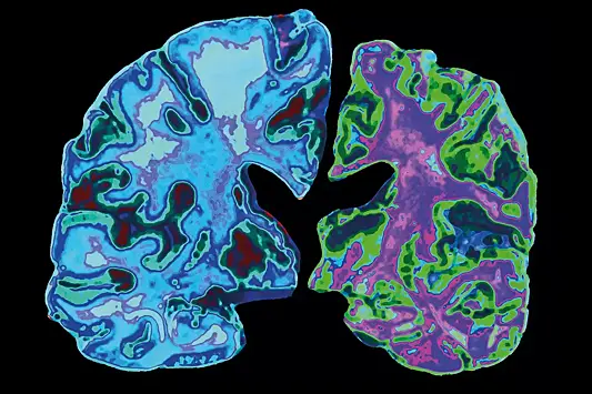 Как болезнь Паркинсона распространяется в мозг