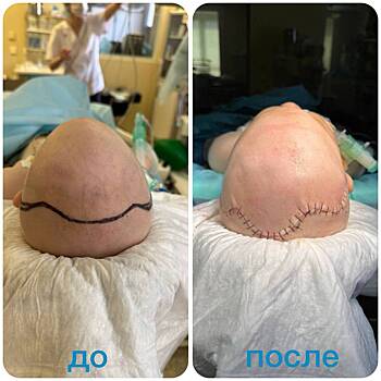 Московские врачи выровняли череп младенцу с «треугольной» головой