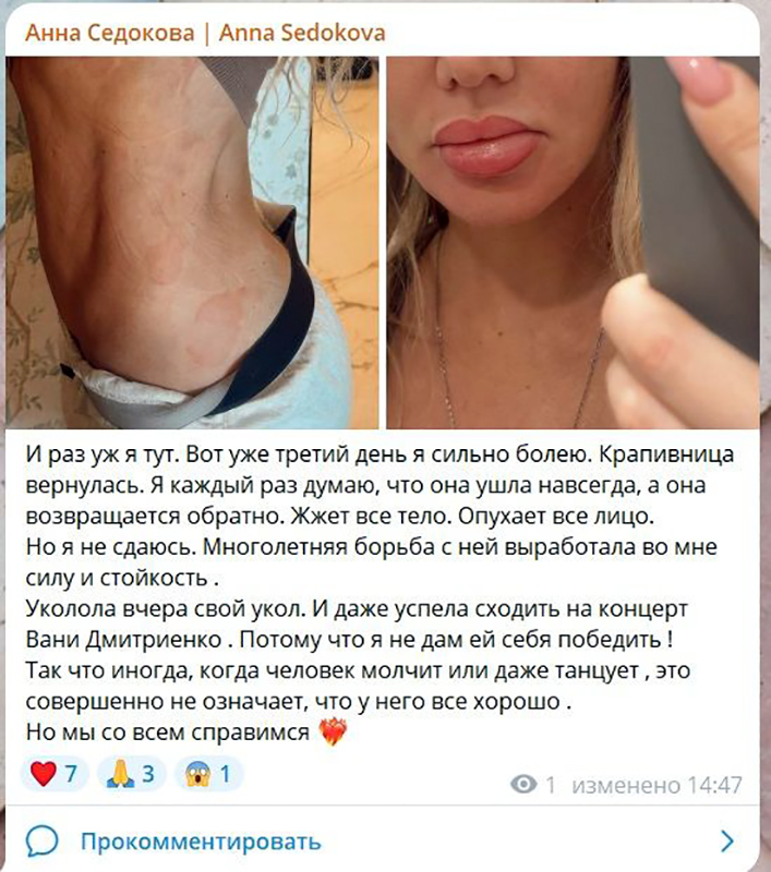 Опухшая Анна Седокова сообщила о рецидиве болезни