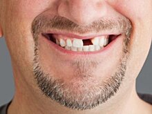 Ученые доказывают: потеря зубов убийственна для сердца