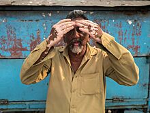 Эксперты рассказали об актуальных неинвазивных методах диагностики витилиго