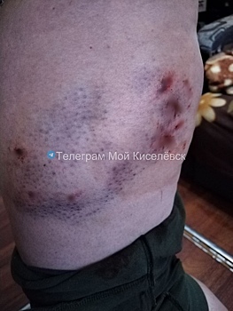 Раны и синяки: стая собак напала на двух человек в Киселевске