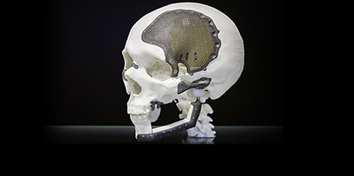 Печать с чистого листа. Уникальные протезы как шанс на полноценную жизнь