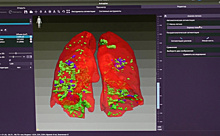 Узнать за 10 минут: самарские медики изобрели систему оценки поражения легких при COVID-19