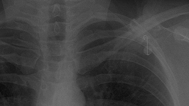 У сибирячки в плече нашли инструменты, забытые врачами 10 лет назад