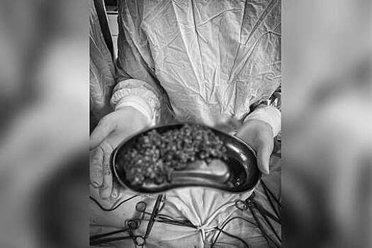 На Кубани врачи спасли женщину с непроходимостью кишечника из-за кукурузы