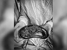 На Кубани врачи спасли женщину с непроходимостью кишечника из-за кукурузы