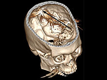 Мужчина выжил после попадания пули в мозг