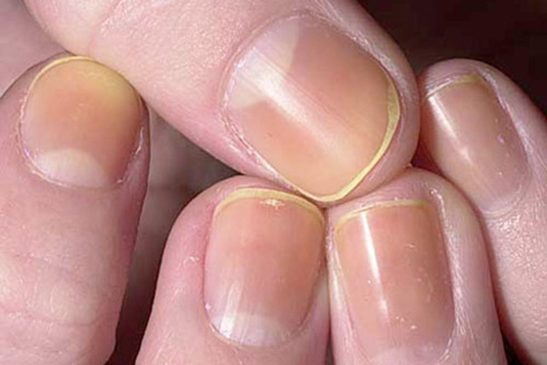 О чем говорит заболевание ногтей. Грибковые болезни ногтей. Желтая ногтевая пластина.
