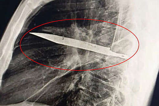 The Sun: африканец пришел к врачу и узнал, что 8 лет прожил с ножом в груди