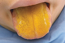 Заболевание окрасило язык мальчика в ярко-желтый цвет