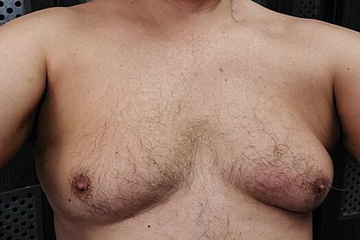 Онколог предупредил о факторах развития доброкачественной опухоли груди у мужчин