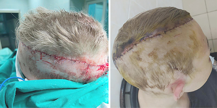 Станок снял скальп с девушки из Подмосковья