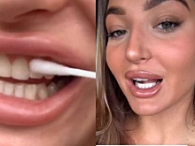 Врачи умоляют фанатов TikTok не втирать в зубы отбеливатель