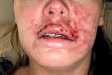 Неумелый косметолог случайно накачал женщине артерию вместо губ