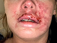 Неумелый косметолог случайно накачал женщине артерию вместо губ