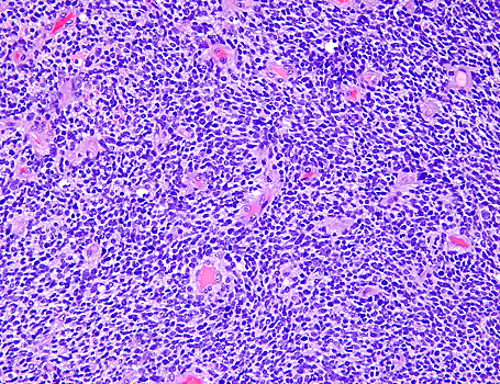 Новый вариант CAR-T-терапии позволил продвинуться в лечении глиобластомы