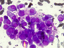 Можно ли заразиться раком?