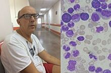 Учёный из Красноярска рассказал, как победил рак крови
