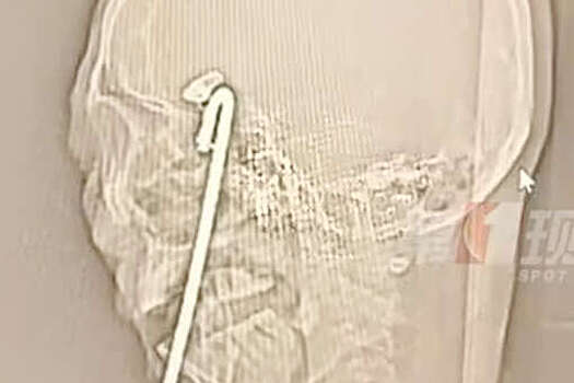 В Китае врачи десять часов спасали мужчину, упавшего в клубе головой на штырь