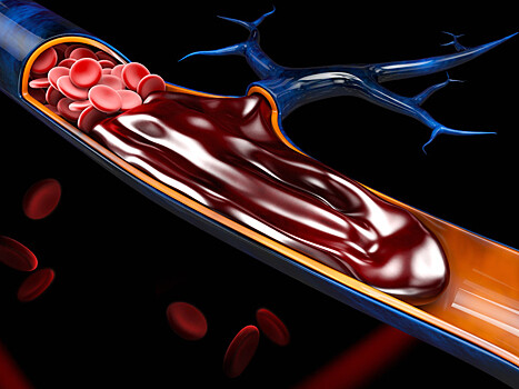 Ученые нашли причину внезапных смертей больных COVID-19 и резкого ухудшение их состояний: тромбоз выявлен у 70% пациентов