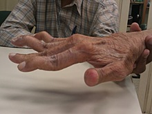 Серонегативный ревматоидный артрит: симптомы, диагностика, лечение