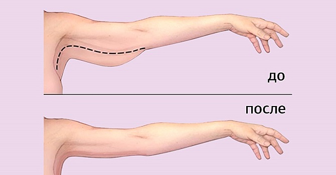 3 эффективных способа от дряблости рук