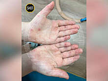 SHOT: россияне жалуются на распространение вируса Коксаки в детсадах и школах