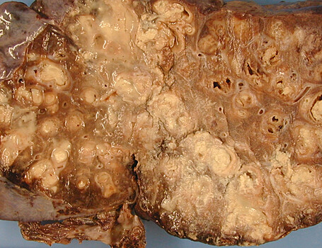 Найдены генетические причины усвоения муковисцидозной терапии