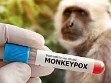В подмосковной больнице выросло число пациентов с оспой обезьян