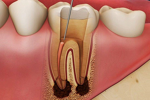 Зачем человеку нужны в зубах нервы
