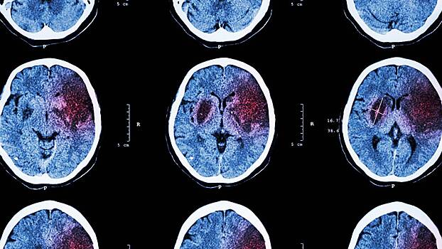 Эксперт: Женщины и мужчины одинаково подвержены инсультам