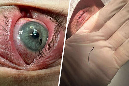 В Подмосковье спасли зрение мужчине с проволокой в глазу после работы в гараже
