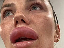 Девушка избавилась от пухлых губ и осталась с раздутым лицом после процедуры