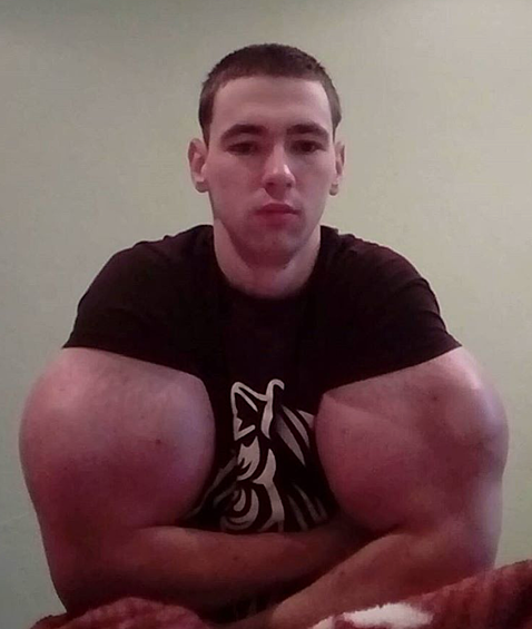 Кирилл Терешин признается, что уколы синтола не были безболезненны. «Поднималась температура под 40, я буквально «умирал», - говорит он