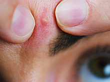 Россиянам рассказали, как быть с неприятной кожной болезнью