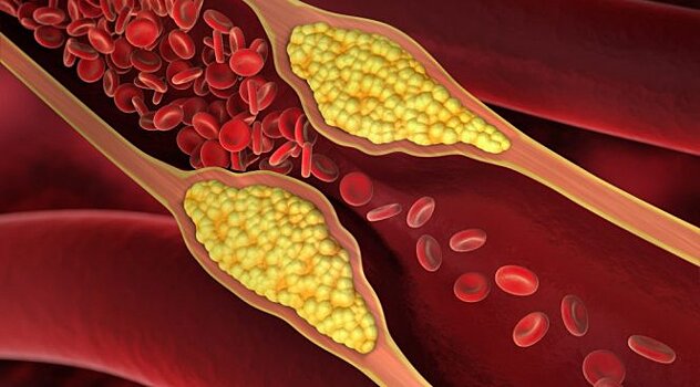 Обнаружен белок, защищающий сосуды от отложений холестерина