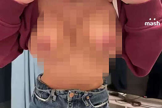 Москвичка сделала пластику груди в элитной клинике, но получила рубцы и ожоги